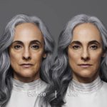 rha_filler_before and after results